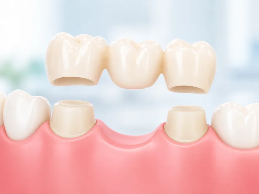 Dental Bridges