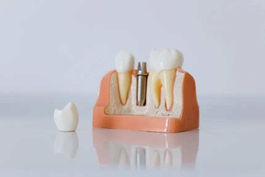 Dental Implant Placement