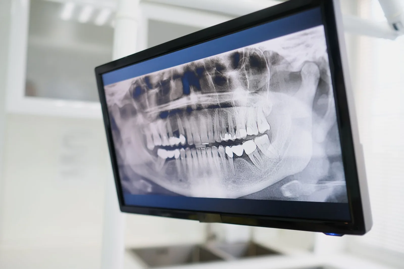 Root Canal Therapy