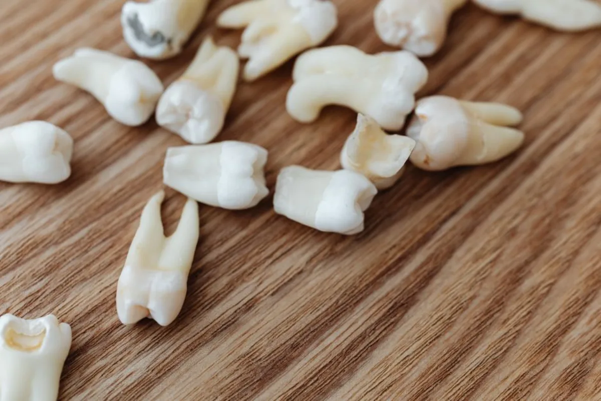 Post-Op Instructions for Wisdom Teeth Removal at SoJo Dental