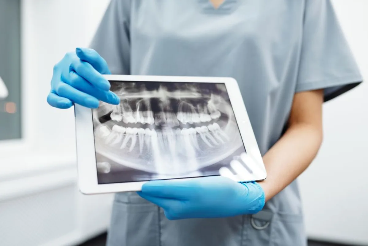 Root Canal Retreatment at SoJo Dental